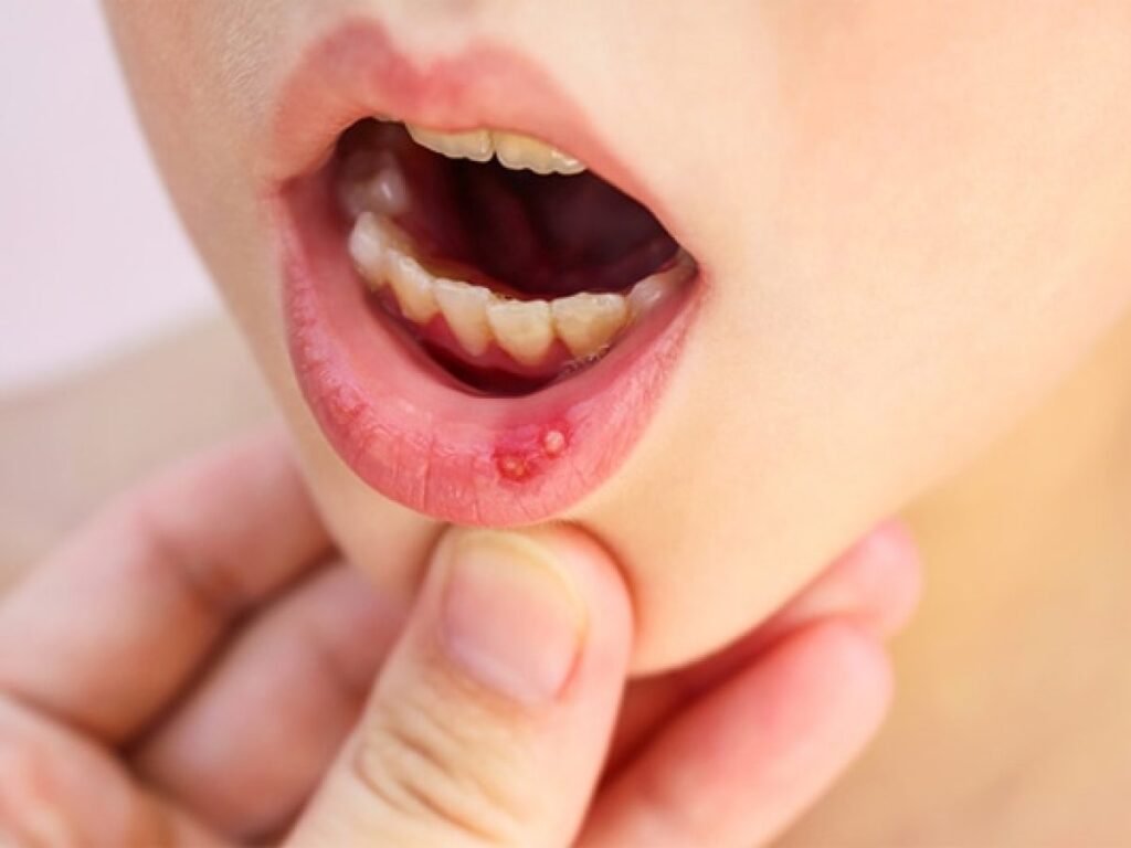 El Ministerio de Salud mantiene control de casos de mano-pie-boca en infantes y el Dengue. 1 CinfaSalud enfermedad boca mano pie 600 1200x900 1