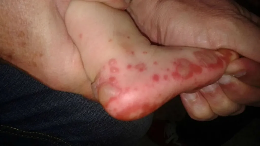 El Ministerio de Salud mantiene control de casos de mano-pie-boca en infantes y el Dengue. 3 enfermedad manos pies y boca