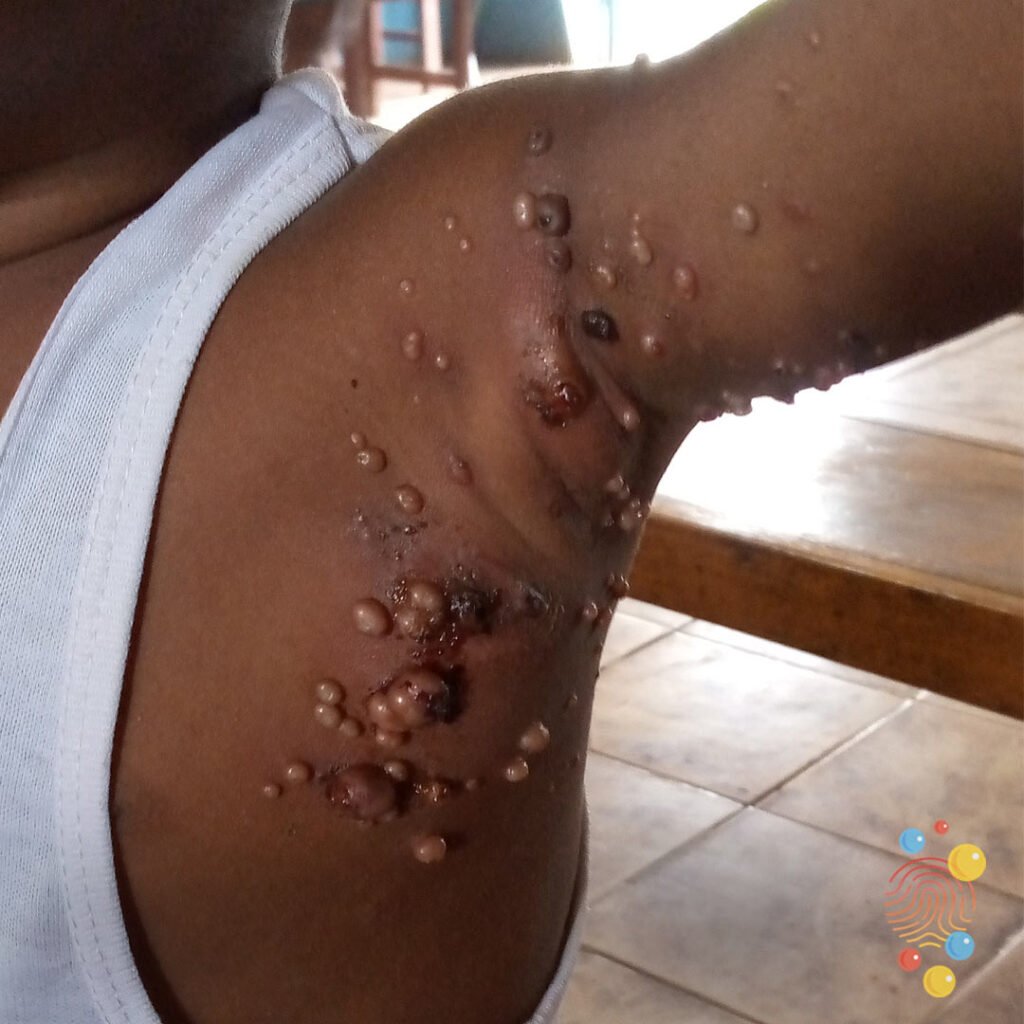 D197a infected molluscum contagiosum 1024x1024 1