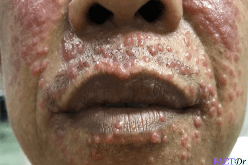 Molluscum Contagiosum lesions