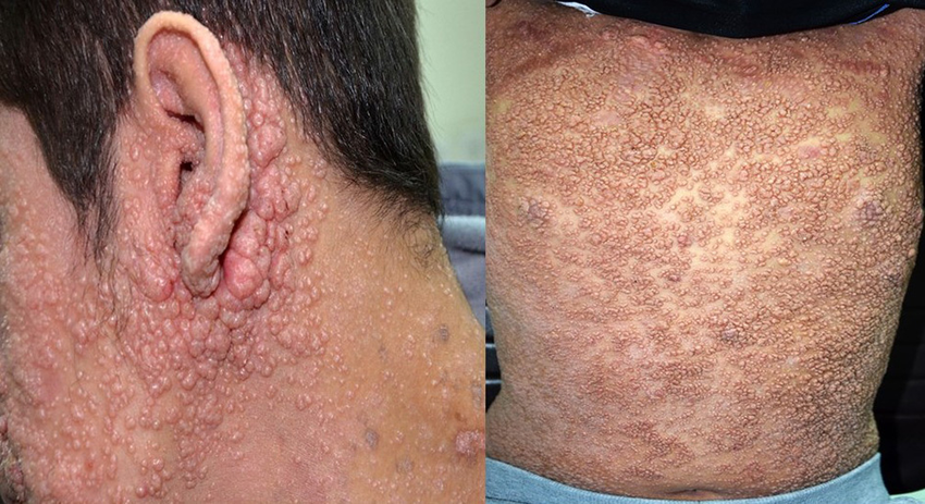 Severe and disseminated molluscum contagiosum in a patient with dedicator of cytokinesis