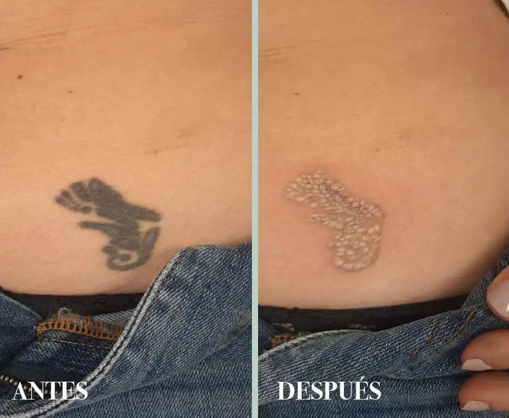 El largo y doloroso camino hacia una piel sin tinta: los desafíos de la eliminación de tatuajes con láser 2 asdasdas