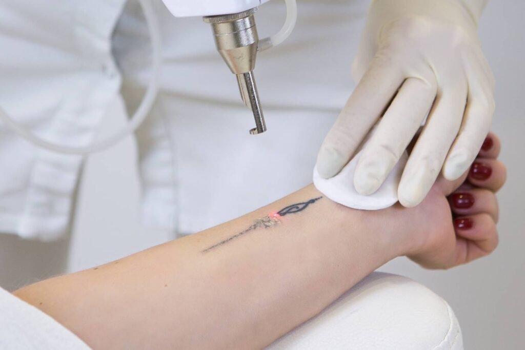 El largo y doloroso camino hacia una piel sin tinta: los desafíos de la eliminación de tatuajes con láser 1 catsasfasf